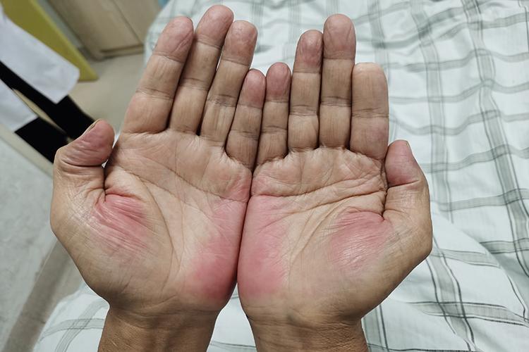 肝癌早期肝掌图