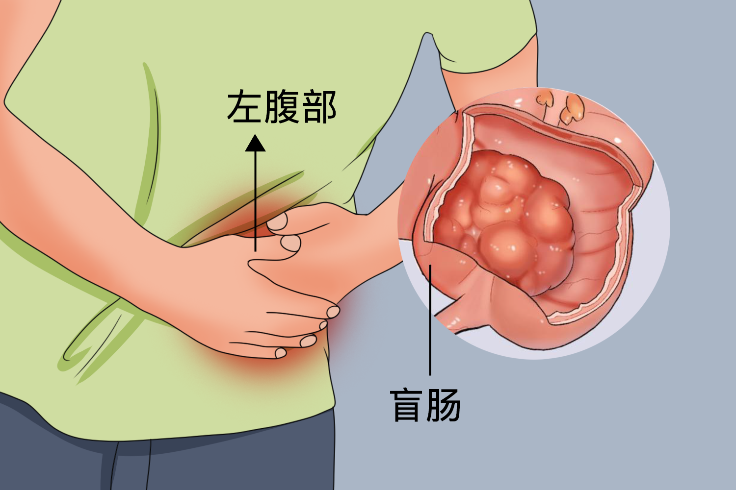 异位盲肠位于左腹部图