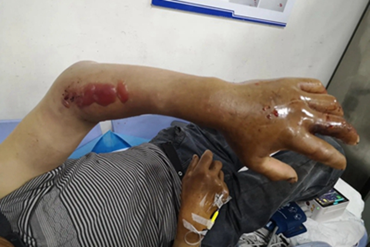 毒蛇咬伤手背上有四个点状伤口图