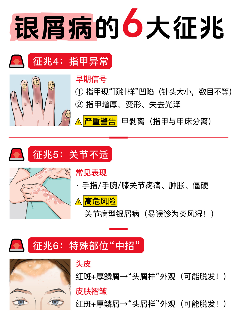 银屑病的6个征兆，速戳，看你有吗？？？