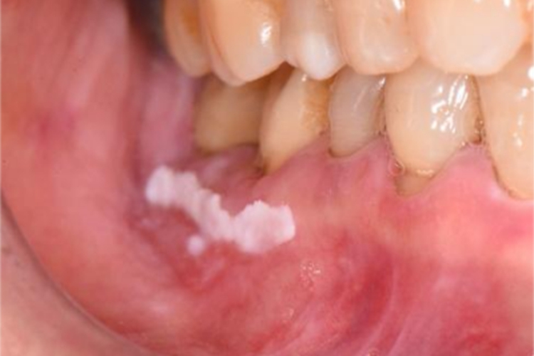 口腔白斑病牙龈症状图