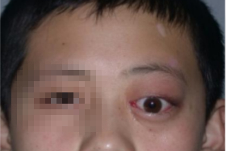 眼眶血肿症状图 眼眶血肿症状图