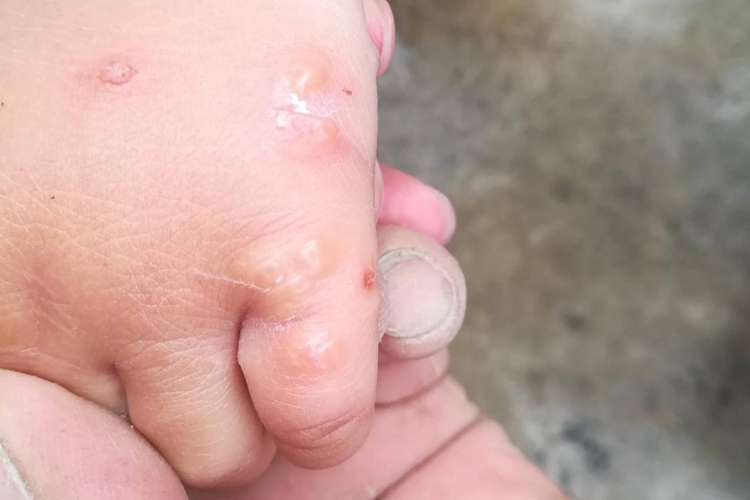 儿童手癣图 儿童手癣图