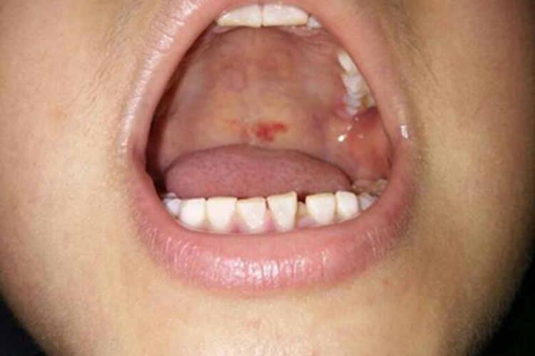 获得性风疹前驱期口腔红斑图 获得性风疹前驱期口腔红斑图