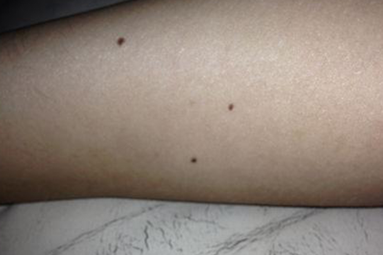 色素痣图 色素痣图
