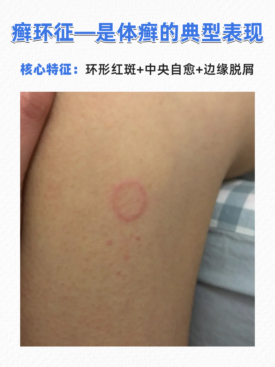 牛皮癣和癣是什么样子的？皮肤科医生一眼区分