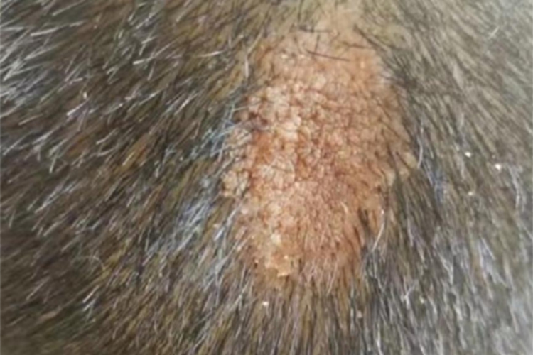 皮脂腺痣肉粒图片 皮脂腺痣肉粒图片