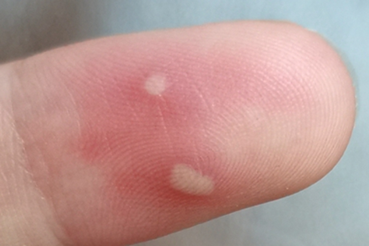 摩擦水疱手指尖症状图
