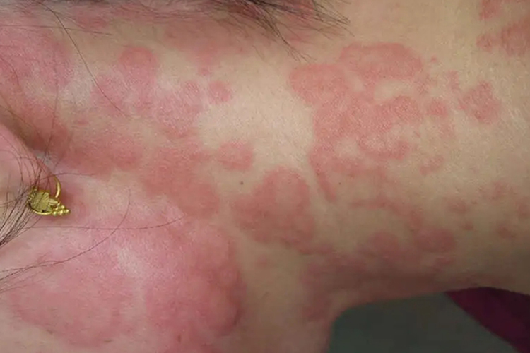 脖子上长荨麻疹图 脖子上长荨麻疹图