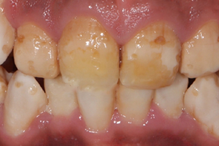 氟斑牙牙齿缺损图 氟斑牙牙齿缺损图