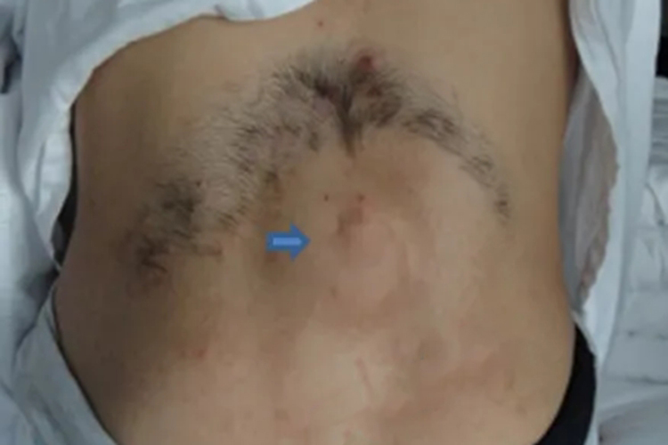 腰骶部多毛图 腰骶部多毛图