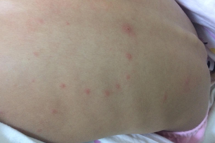 小朋友背后起水痘图 小朋友背后起水痘图