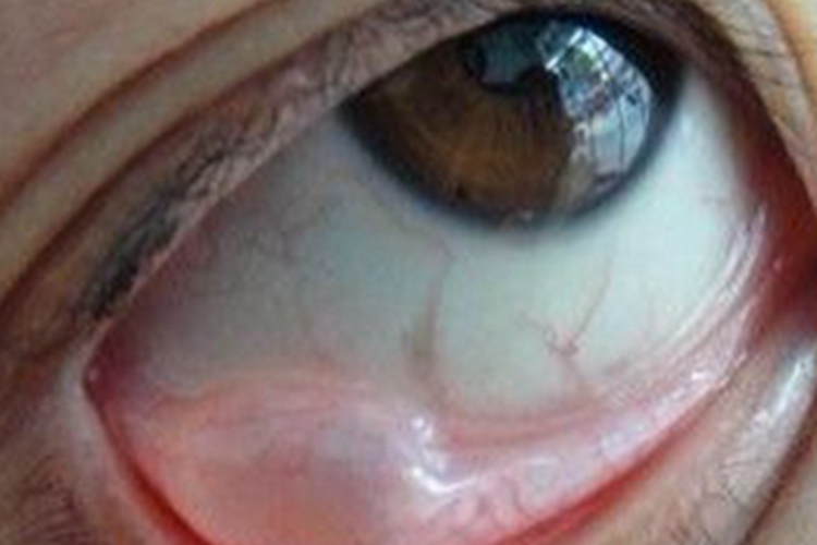 常年性过敏性结膜炎结膜水肿图