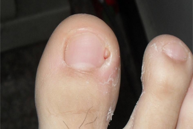 结节性硬化症脚趾疙瘩图 结节性硬化症脚趾疙瘩图