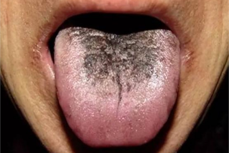 毛舌舌头中间黑色图