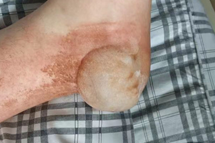 急性接触性皮炎脚后跟症状图