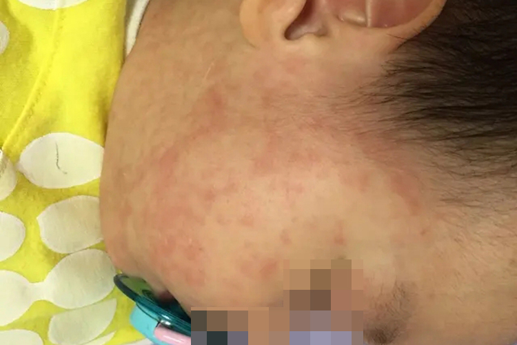 婴儿急疹面部图