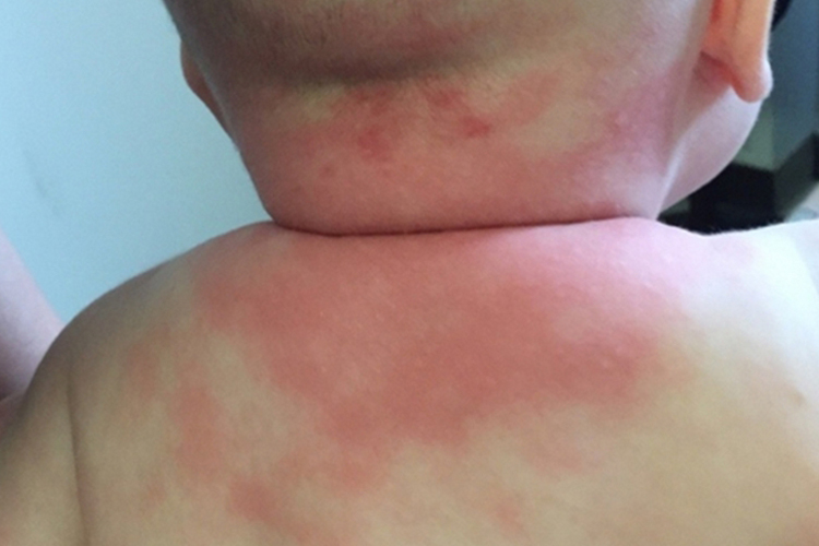 接触性皮炎宝宝脖子红斑图 接触性皮炎宝宝脖子红斑图