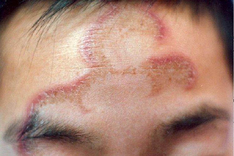 亚急性皮肤型红斑狼疮前额症状图