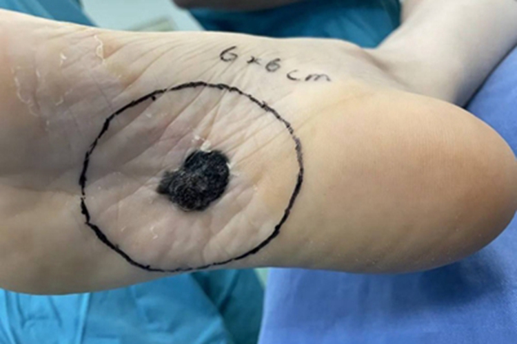 恶性黑色素瘤脚底症状图