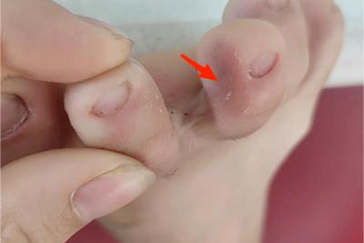 浸渍糜烂型足癣脚趾脱屑图