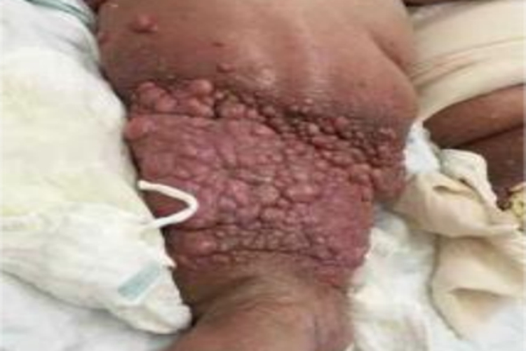 丝虫病慢性期小腿疙瘩图