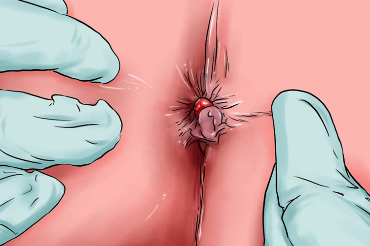 内痔结节手绘图 内痔结节手绘图