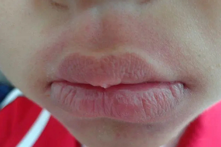 豌豆过敏口周红斑图