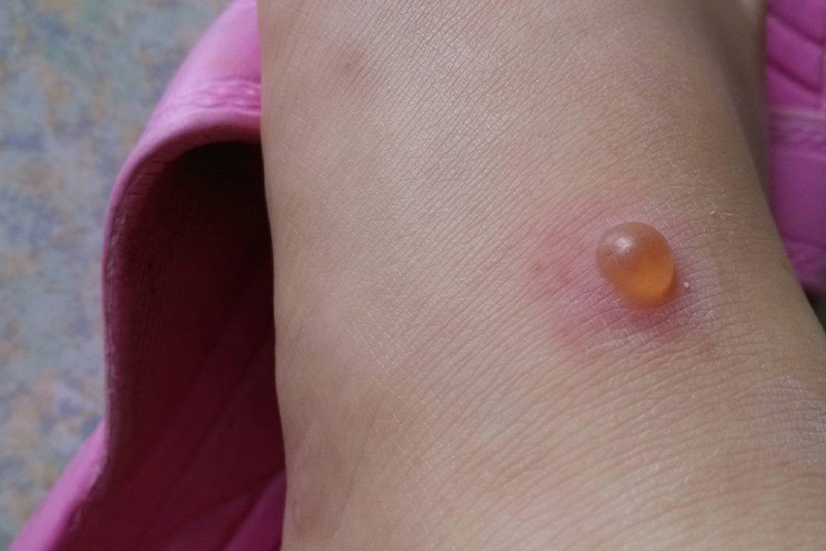 毒虫叮咬后水疱图