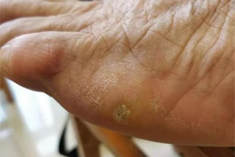 软鸡眼脚部症状图