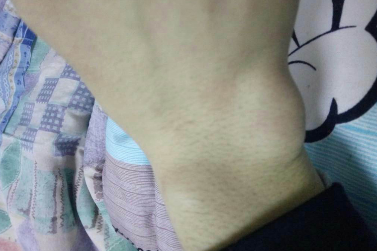 骨关节结核症状图 骨关节结核症状图