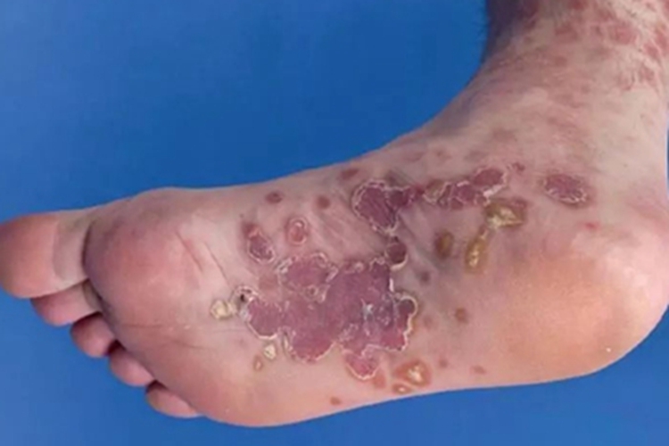 斑疹性梅毒疹脚底紫斑图