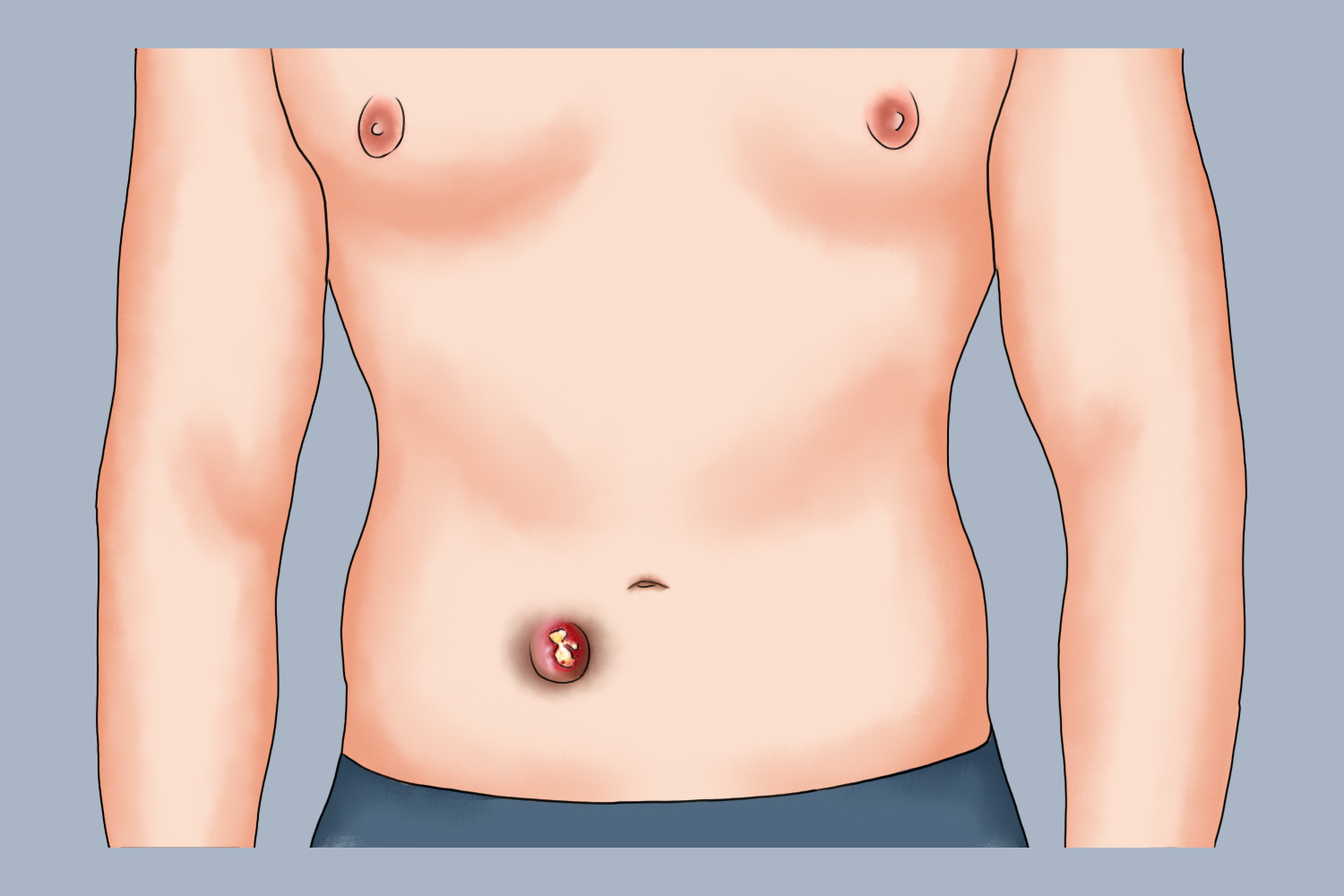 腹壁痈图 腹壁痈图