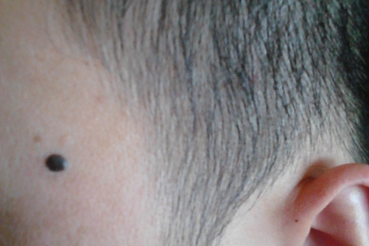 脸上有圆形色素痣图 脸上有圆形色素痣图