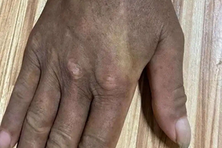 家族性进行性色素沉着手部症状图