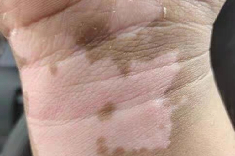 非节段型白癜风手腕症状图