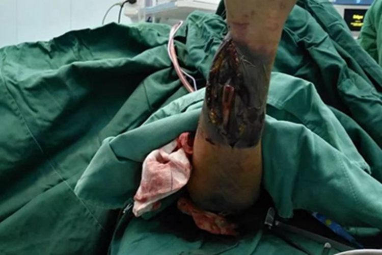 气性坏疽胳膊皮肤发黑图 气性坏疽胳膊皮肤发黑图