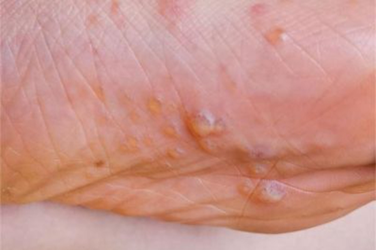 脓窝疮脚底有很多水疱图