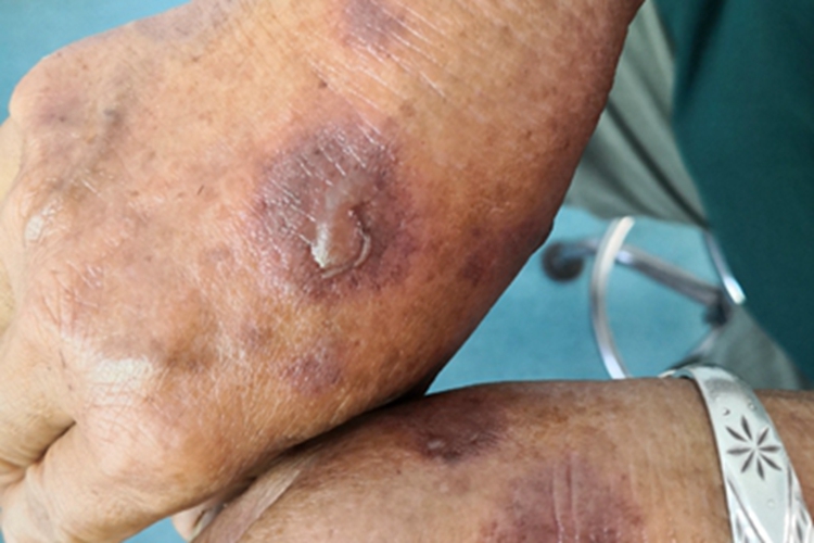 轻型多形红斑型药疹手背紫斑图