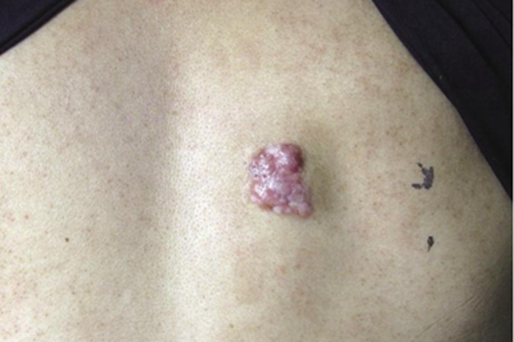 成人型纤维肉瘤背部症状图