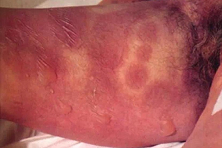 中毒性表皮坏死松解症大腿水疱图