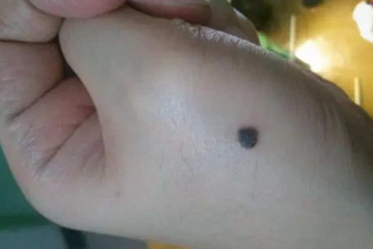 良性幼年黑素瘤手部症状图 良性幼年黑素瘤手部症状图