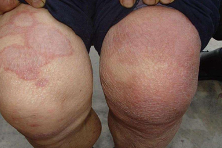 结核样型麻风膝盖症状图