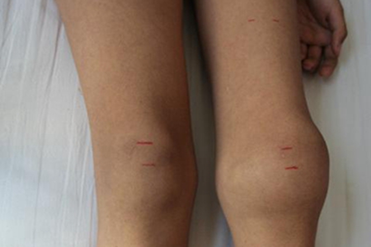 血友病长大包图