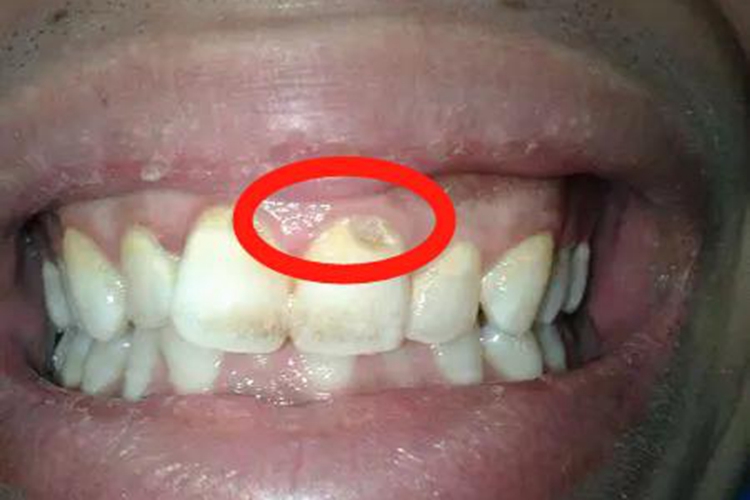 门牙根部被腐蚀了一个小坑图
