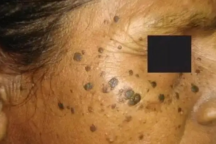 面部脂溢性角化病图 面部脂溢性角化病图