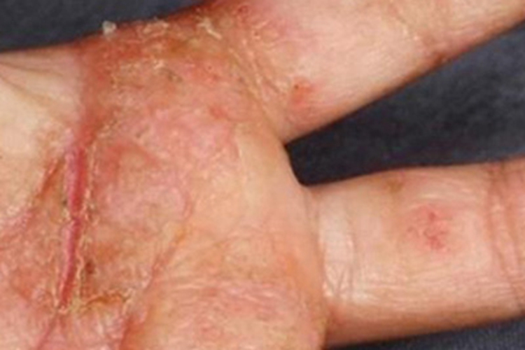 急性湿疹皲裂图 急性湿疹皲裂图