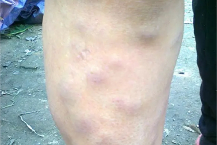 皮肤猪囊虫病小腿症状图