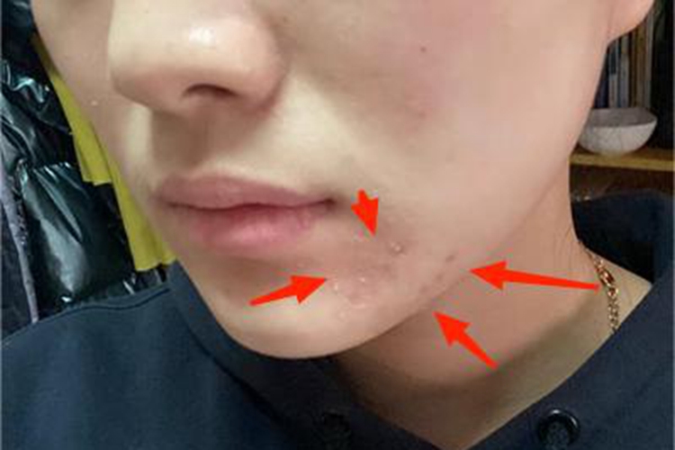 痤疮下巴有色斑脱皮图 痤疮下巴有色斑脱皮图