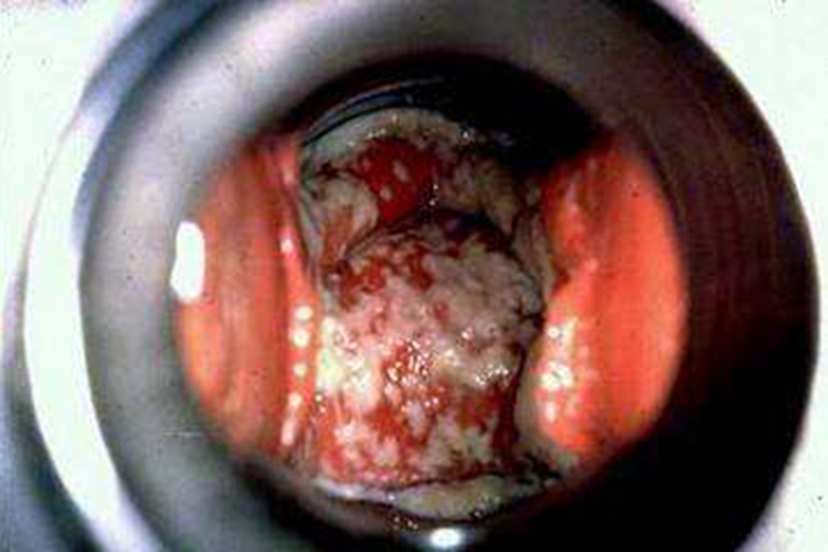 阴道溃疡图 阴道溃疡图